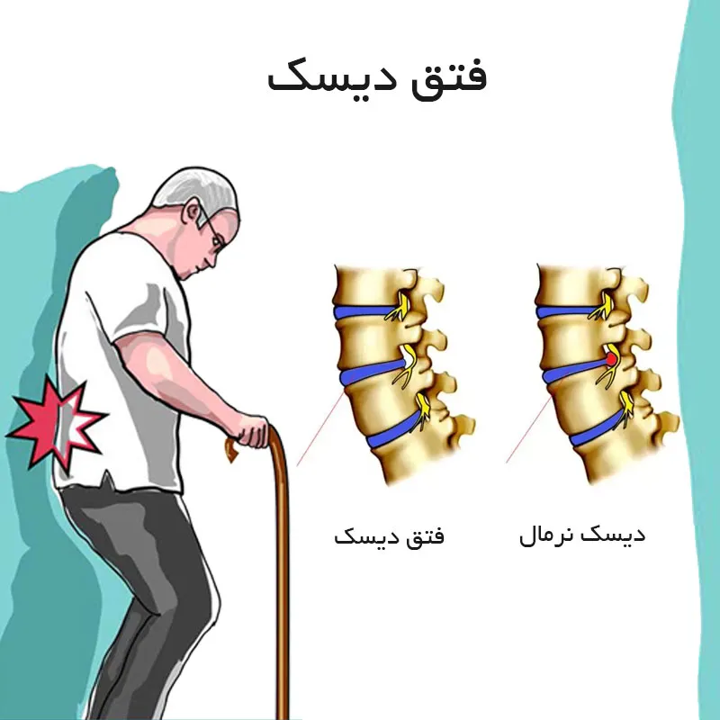 فتق دیسک کمر چیست و راه‌های درمان آن 