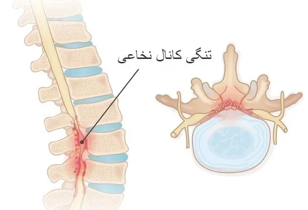تنگی کانال نخاع چیست و چگونه درمان می‌شود؟