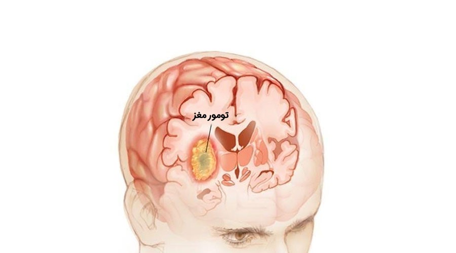علائم تومور مغزی: شناسایی، پیشگیری و درمان