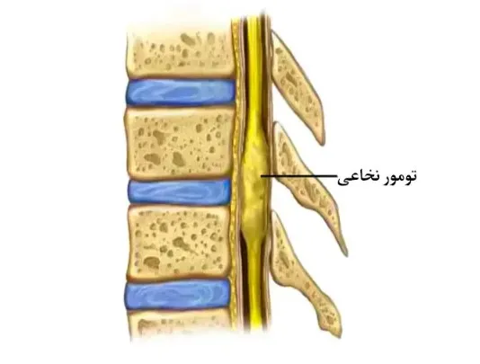 تومور نخاعی چیست؟ علائم، تشخیص، درمان