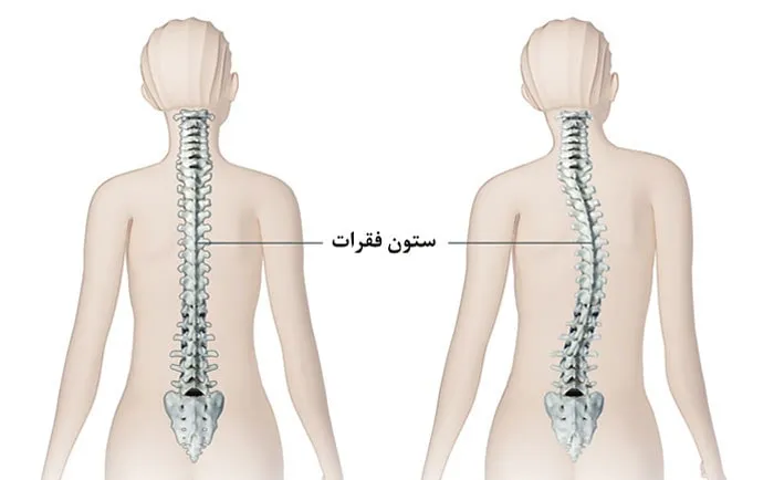 اسکولیوز چیست؟ انحنای ستون فقرات در نوجوانان