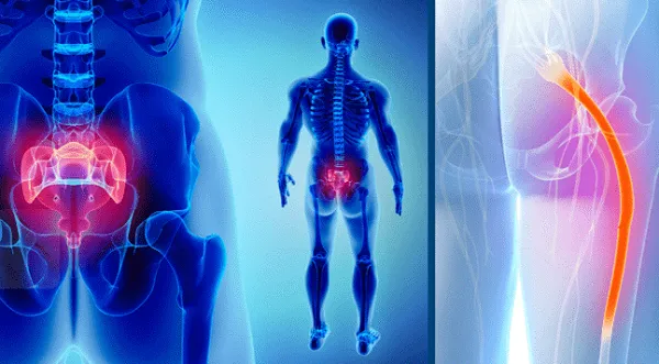 علائم پاره شدن رگ سیاتیک چگونه ظاهر میشود؟