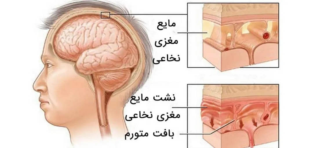 مایع مغزی نخاعی چیست و چه نقشی در بدن دارد؟
