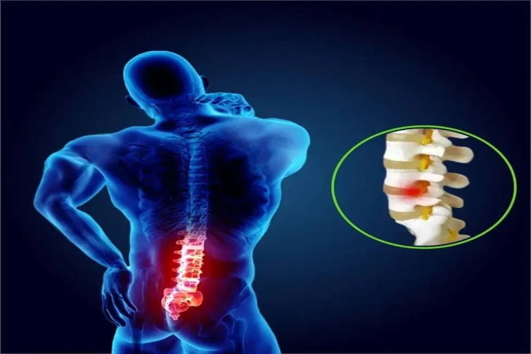 تنگی کانال نخاع چیست و چگونه درمان می‌شود؟