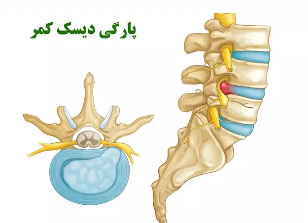 علائم پارگی دیسک کمر و درمان آن: راهنمای جامع و کاربردی