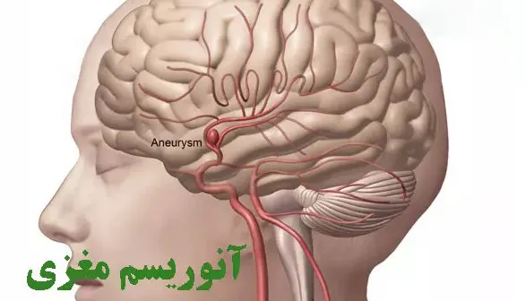 آنوریسم مغز چیست؟