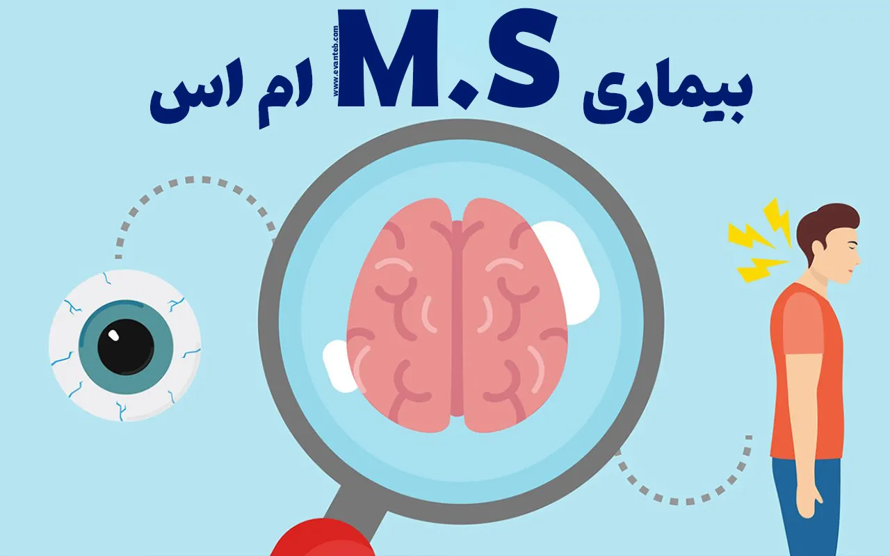 نشانه‌های بیماری ام اس چیست؟ علائم، پیشگیری و درمان‌ها